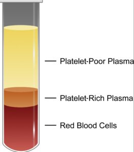 PRP Hair treatment Platelet-Rich Plasma